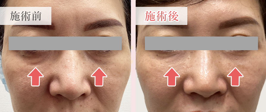 RRS HYALIFT 75 PROACTIVEの症例写真3